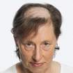 Niechirurgiczne uzupełnianie włosów Dorota Olejniczak zdjęcie 2
