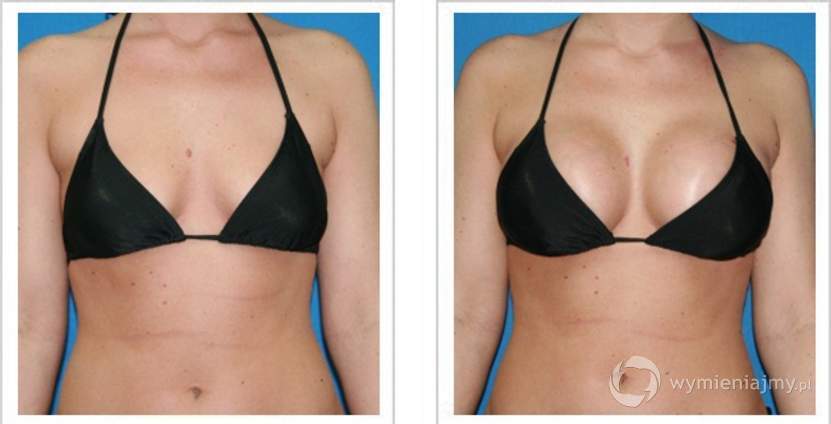 Nieoperacyjne rozwiązanie powiększania piersi i pośladków zdjęcie 1
